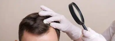 calvitie-homme calvitie-homme