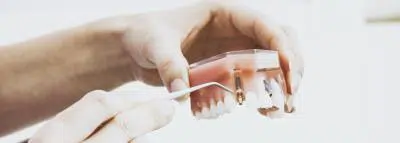 Agénésie dentaire : implant et remboursement implant-dentaire-rembousement